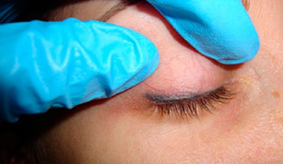 Détatouage des yeux au laser des paupières. Photos avant et après, conséquences