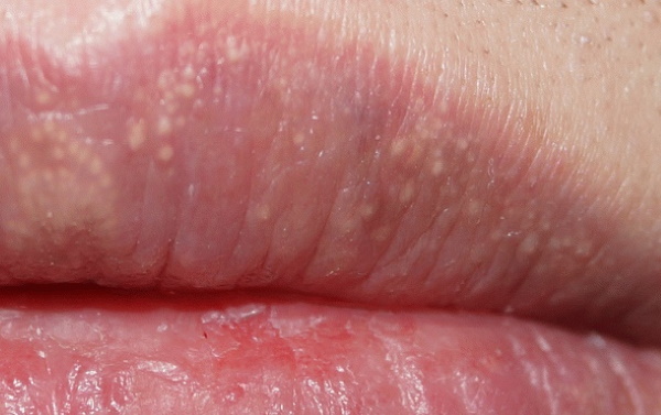 Granules Fordyce et maquillage permanent des lèvres. Photos avant et après, avis