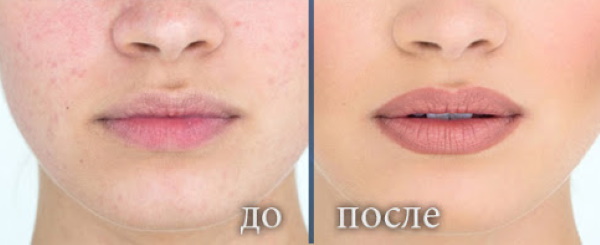 Granules Fordyce et maquillage permanent des lèvres. Photos avant et après, avis